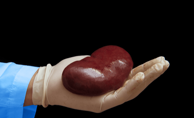 kidney transplant