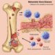 Metastatic Bone Disease Market Projected to Reach USD 36.4 Billion by 2031, with 8.7% CAGR Growth Amid Rising Cancer Rates and Awareness Efforts