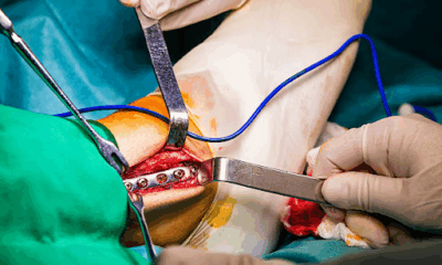 High Tibial Osteotomy