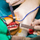 High Tibial Osteotomy