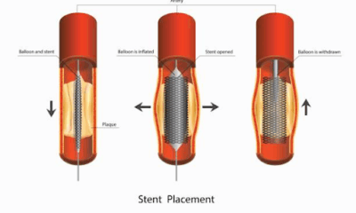 Stents and Related Implants